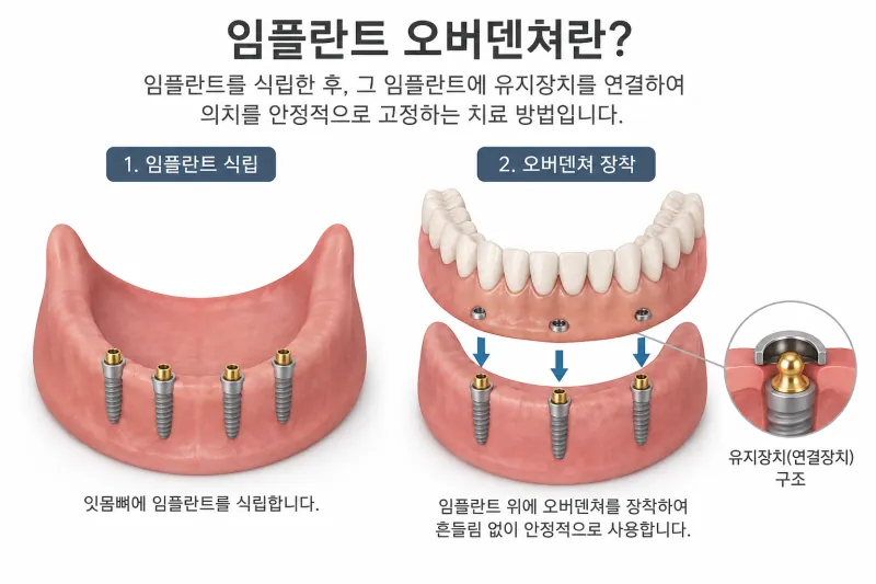 오버덴쳐란