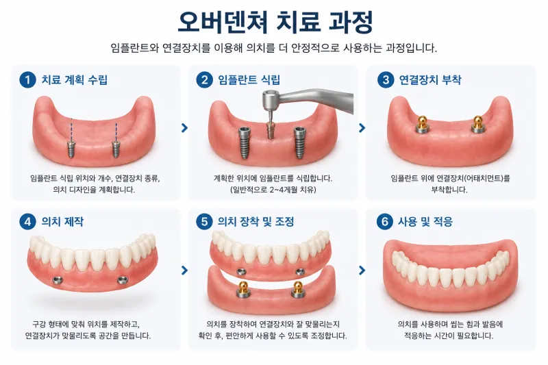 전악 임플란트와 차이