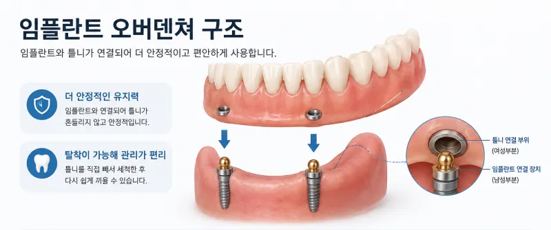 전체 임플란트와 비교, 오버덴쳐에 대해서