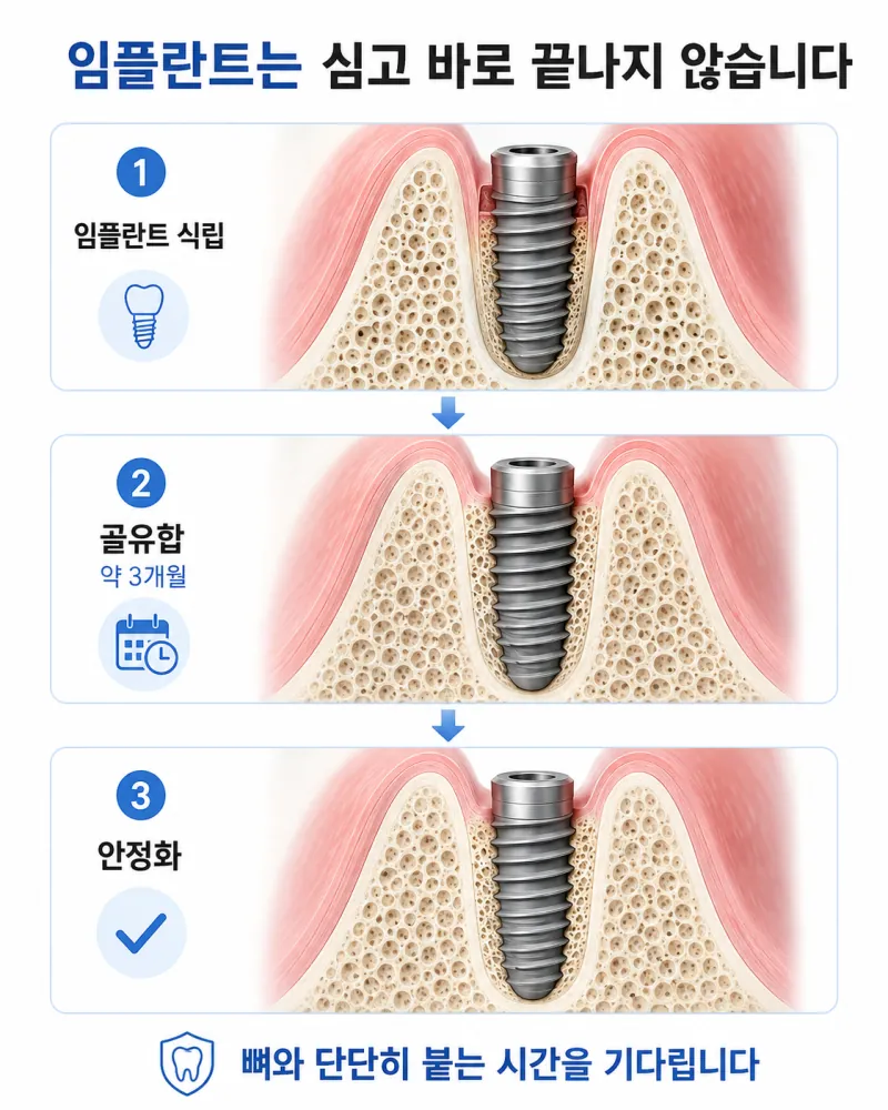 1차 임플란트 식립과 골유합