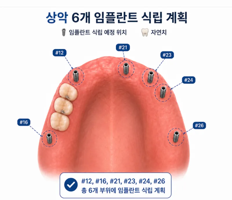 여기서 중요한 점은 기존 틀니를 무조건 없애고 새로 시작한 치료가 아니라…