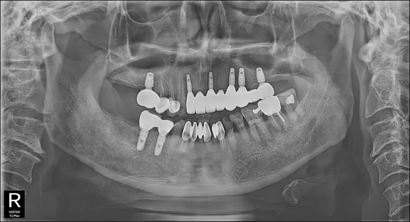 상악 임플란트 부분틀니 불편해진 환자의 치료 사진 6